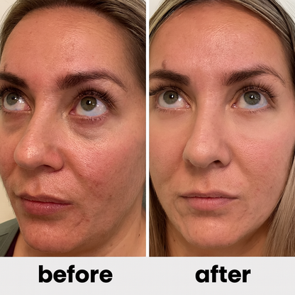 Dermavéra MicroLifting